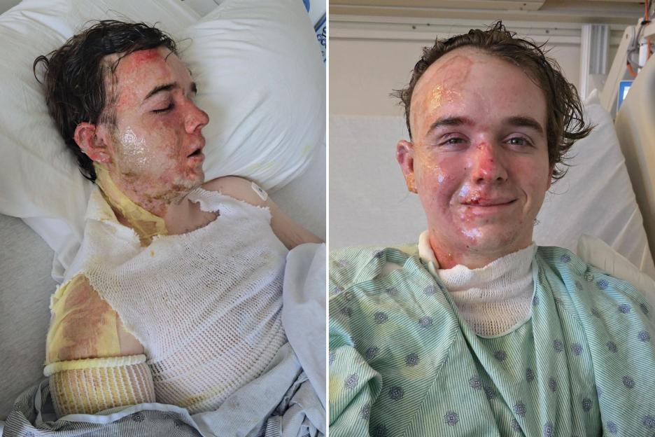 20-Year-Old McDonald’s Worker Hospitalized with Severe Burns After Co-Worker Allegedly Splashes Hot Oil on His Face