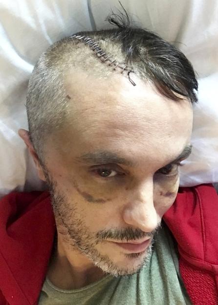 Alastair Wallace in a hospital bed with staples in his scalp and bruises on his face after suffering a severe head injury from a fall.