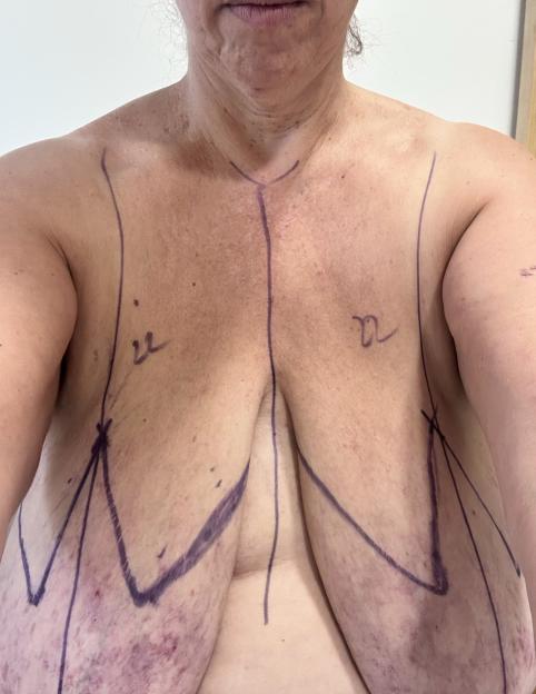 'My 38JJ boobs gave me arthritis - NHS denied me surgery'