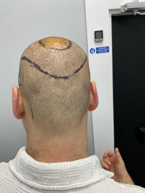 Back of a man's head after a hair transplant, with a shaved scalp, a yellow antiseptic stain on the crown, and surgical lines drawn with a marker.