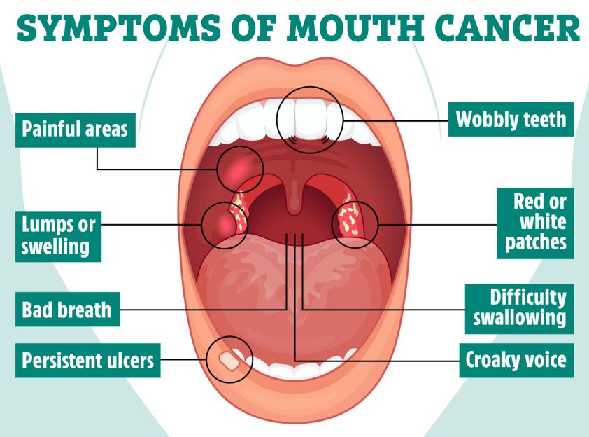 Illustration of mouth cancer symptoms.