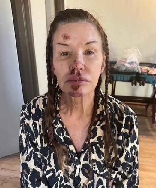 Janice Dickinson with injuries on her face.