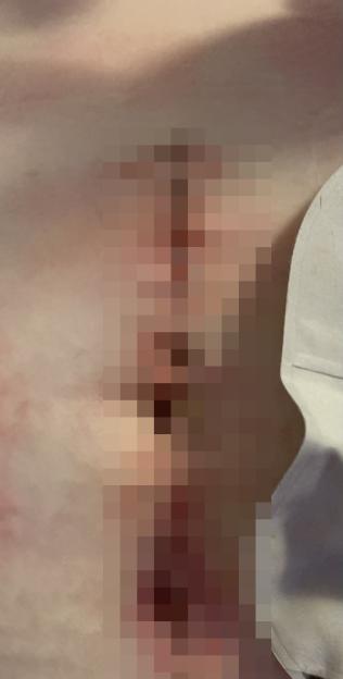 'Doctors removed my vulva and bum after horror cancer ravaged my body  it started with itching that left me feeling on fire'