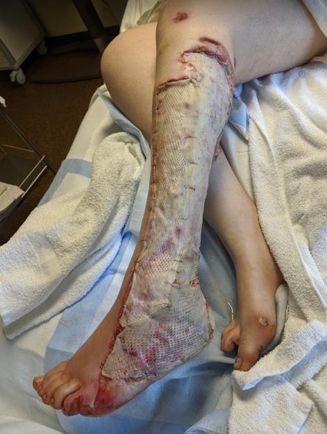 Leg with severe burns and skin grafts.