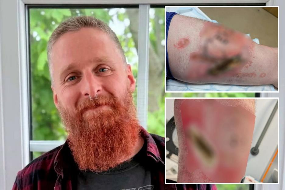 40-Year-Old Man Suffers Severe Burns and Collapses After Vape Explodes in His Pocket