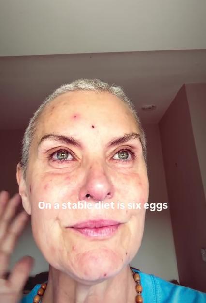 Tracy Shaw showing chemotherapy side effects on her skin.