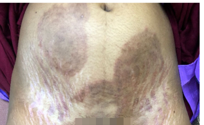 Patches of Trichophyton indotineae on the lower abdomen, groin, and thighs.