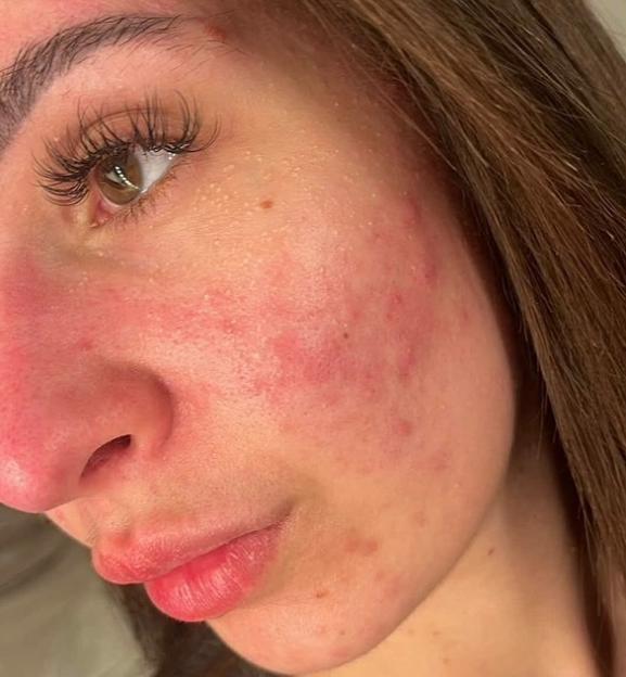 Emily Howdle's face before treatment for blemishes.