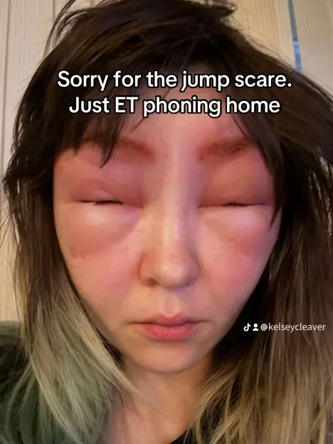 Woman with a severe allergic reaction causing her eyes and forehead to swell, with text "Sorry for the jump scare. Just ET phoning home".