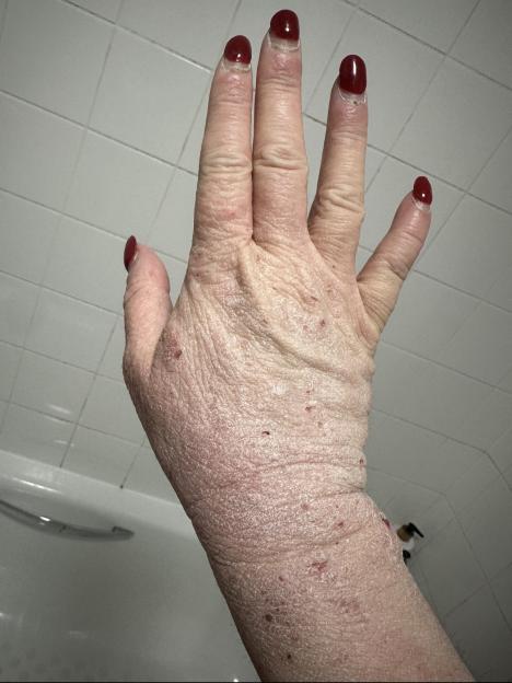 A close-up of Sophie's hand, showing reddened, scaly, and irritated skin, with some small sores and flaking around the fingernails, which are painted red.
