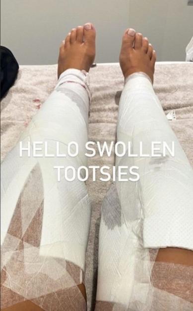 Bandaged legs and visible feet of a person after liposuction, with text "HELLO SWOLLEN TOOTSIES".