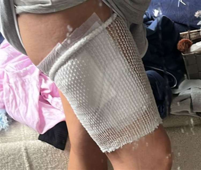 Sarah Tragner's leg is wrapped in a white bandage and medical mesh, covering burn injuries.
