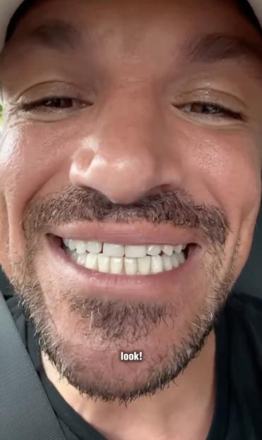 Peter Andre smiling, showing his repaired teeth after emergency dentistry.