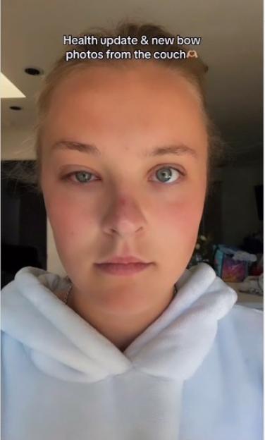 JoJo Siwa with a swollen eye and red nose from battling a concussion and infection.