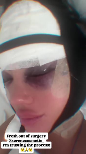 Yazmin Oukhellou with a bruised face and bandages after cosmetic surgery.