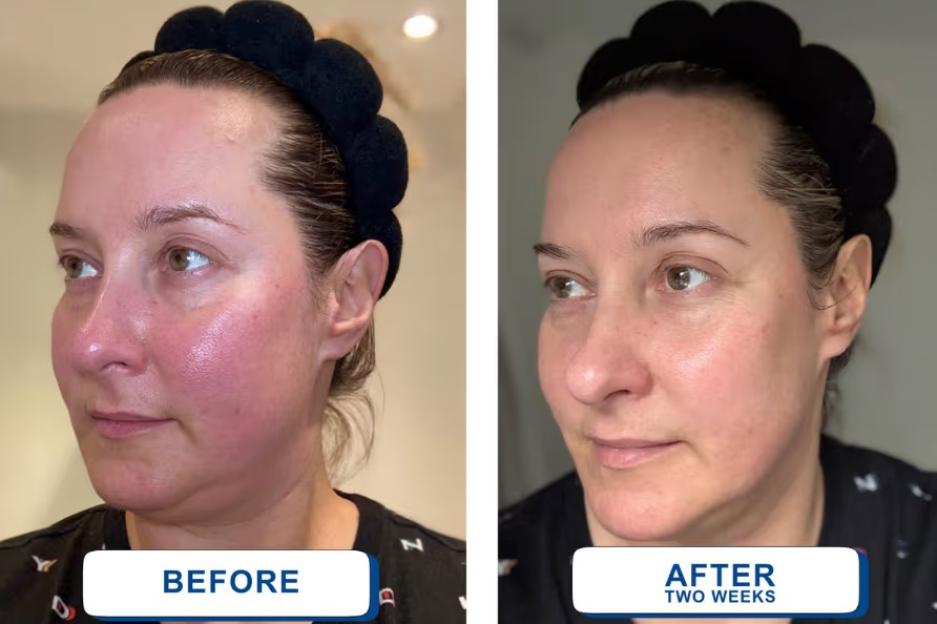 I Disliked My Rosy Pink Skin, So I Tried a £5 Serum for Two Weeks—The Results Were Incredible!