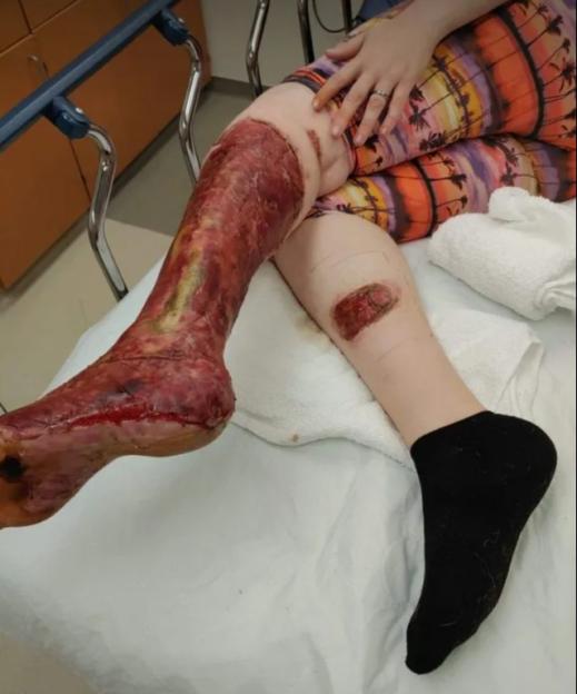 Ashley's severely burned and grafted leg after falling into a campfire.