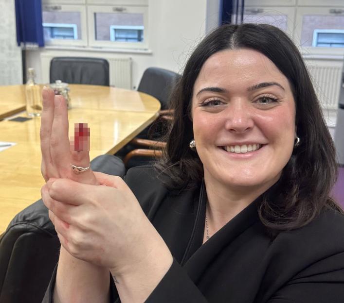 Lucy Crabb holds up her hand showing her pinkie finger after it was chopped off.