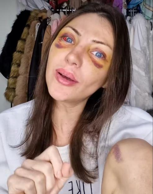 A woman with bruised eyes and a bruised arm speaks to the camera.