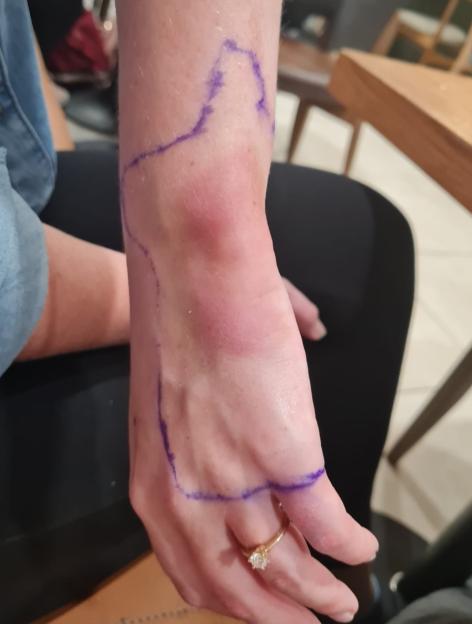 A person's hand and wrist, showing redness and swelling outlined with a purple marker, wearing a diamond ring.