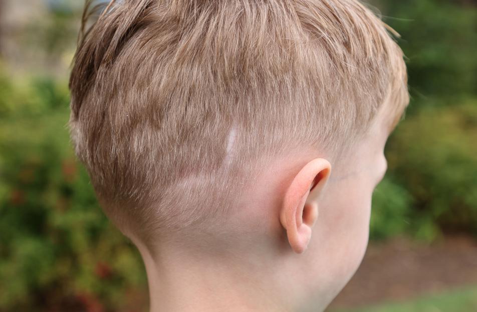 A child's head showing a light-colored scar through their hair on the side of their head above their ear.