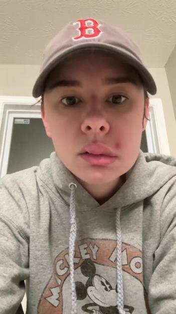 Woman with an infection and scarring on her upper lip and cheek.