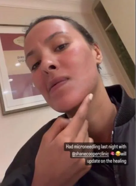 Maya Jama showing her red raw face after undergoing a skin tightening procedure.