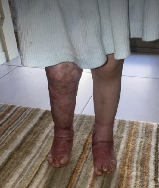 Close-up of a young girl's legs, showing her left leg with burn scars and the right leg appearing normal, standing on a striped rug.