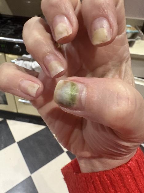 A close-up of a person's hand showing a thumb with a green-tinged nail and several other fingers with yellowish, peeling nails.