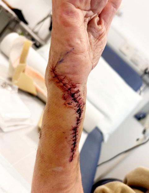 Linda Harris's arm with stitches from her injuries.
