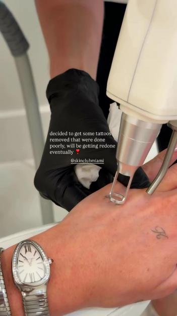 Kate Cassidy getting tattoos removed from her hand.