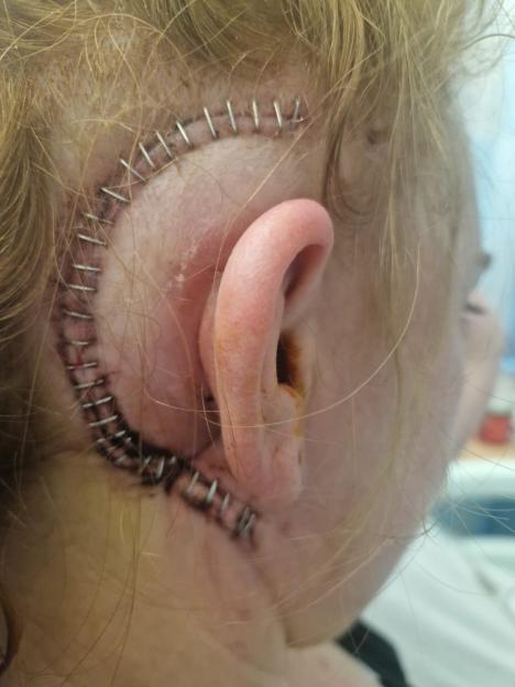 A person's head with surgical staples behind their ear.