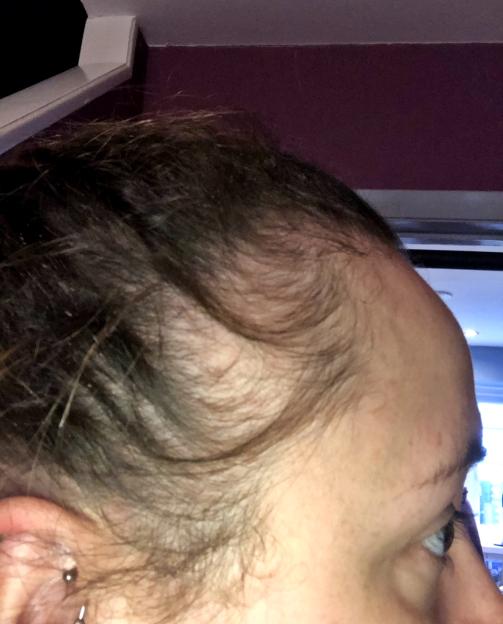 Close-up of Charmaine Hines' hair loss.