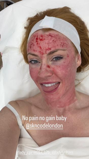Strictly star Chris Robshaw’s wife shares snap of her bloodied face months after needing oxygen from skin treatment