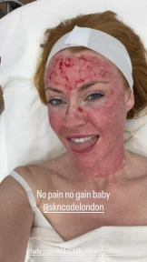 Strictly star Chris Robshaw’s wife shares snap of her bloodied face months after needing oxygen from skin treatment
