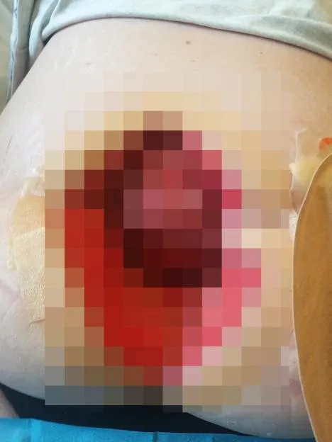 Woman's bowel explodes after 50 pieces of faecal matter became lodged in stomach
