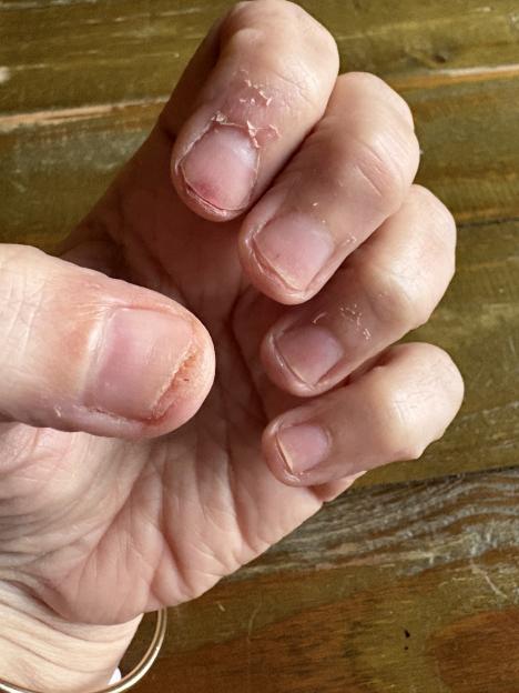 A person's hand with fingers showing peeling skin and red, irritated cuticles.