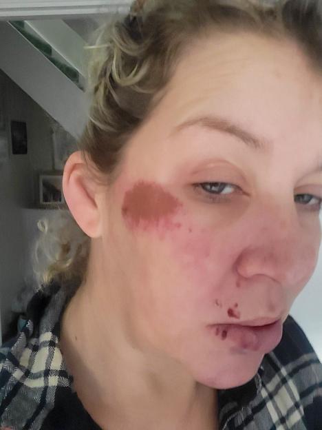 SNPothole- mother whose life has been changed forever after she tripped on a deep pothole said no one has taken responsibility