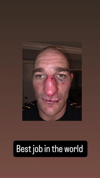 Sean Strickland's face is bruised and swollen after his win over Khamzat Chimaev.