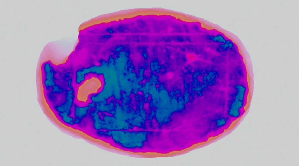 False color image of a kidney stone.