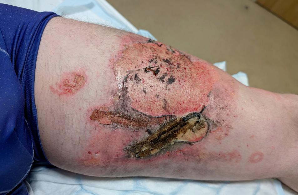 Gavin Sutherland's leg with severe burns caused by an exploding vape battery.