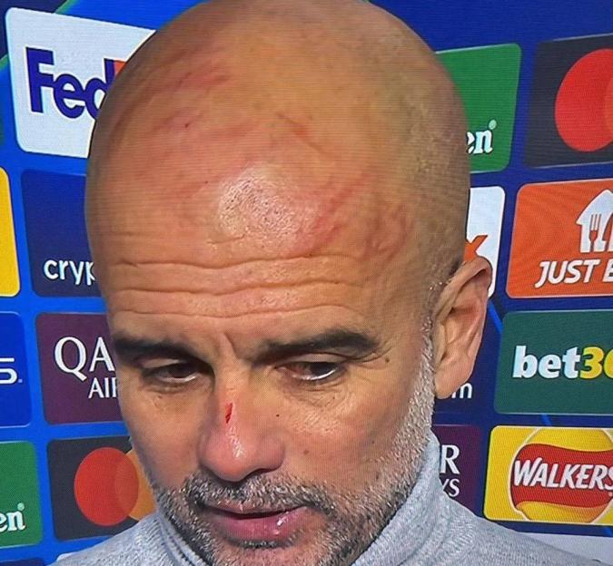 Pep Guardiola with scratches on his head and a cut on his nose.