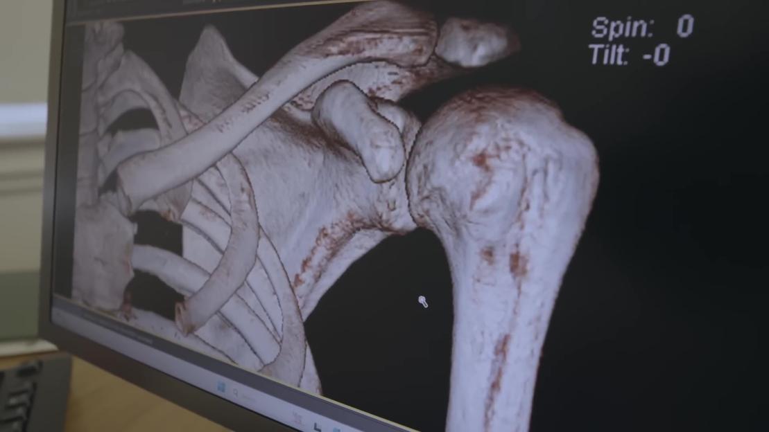 3D scan of a shoulder and ribcage bones on a monitor.