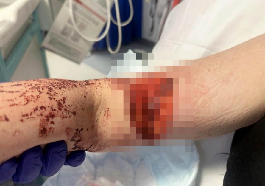 'I adopted a dog from Facebook - weeks later he attacked me and I needed surgery'