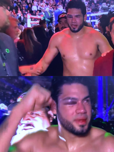 Collage of a boxer with a severely swollen black eye and a bleeding lip after a fight.