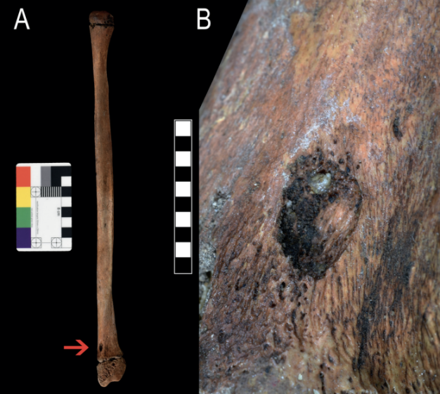 Collage of an adult ulna with a small lesion on the distal end and a magnified view of a lesion.