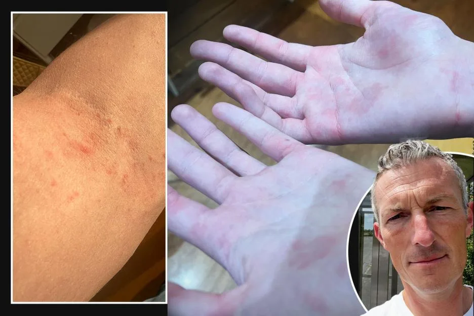 My family were blighted by ‘Victorian disease’ caused by parasitic mites – we were forced to isolate for weeks