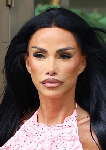 Katie Price Reveals Stunning Results of Her Lip Lift Surgery Despite Bruising from the Painful Procedure