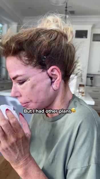 Caroline Stanbury shows off surgery scars and bruised, swollen face after getting a facelift.