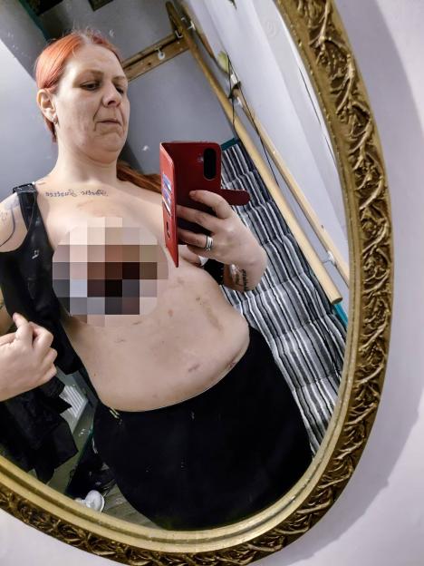 A woman with red hair takes a mirror selfie, showing scars on her chest and stomach.